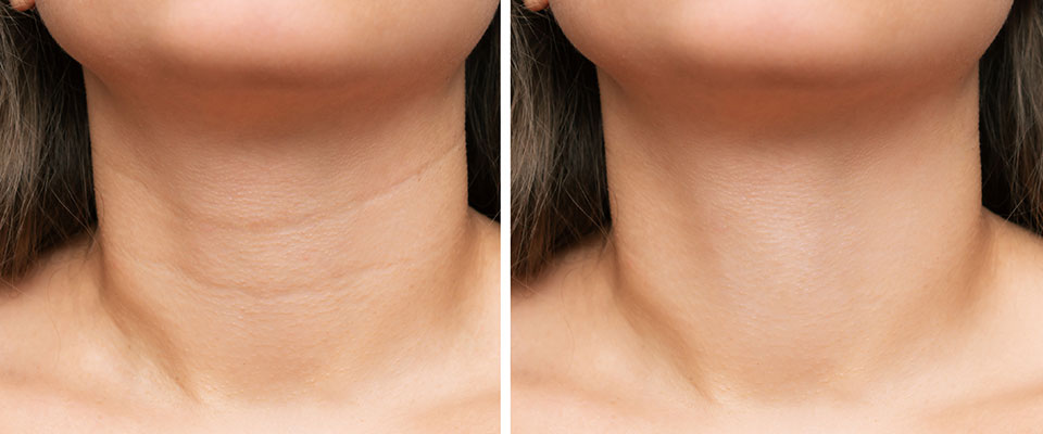 Creme Lifting Firmador Remover Rugas em 60 segundos